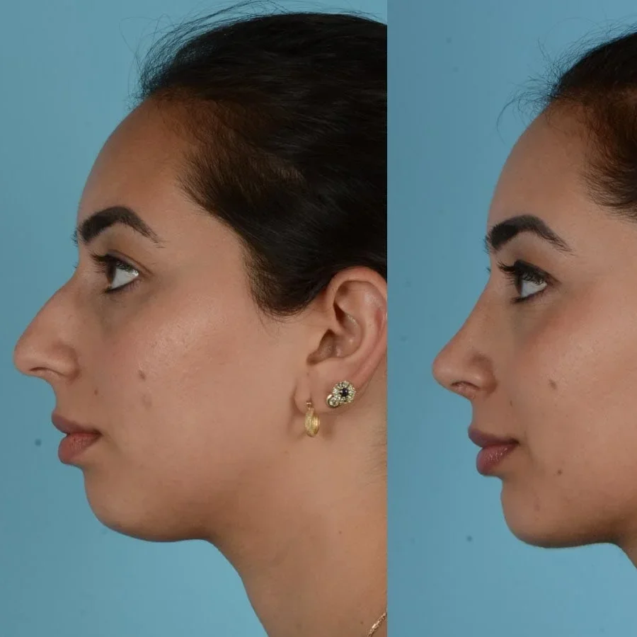 Insivo - Rhinoplasty