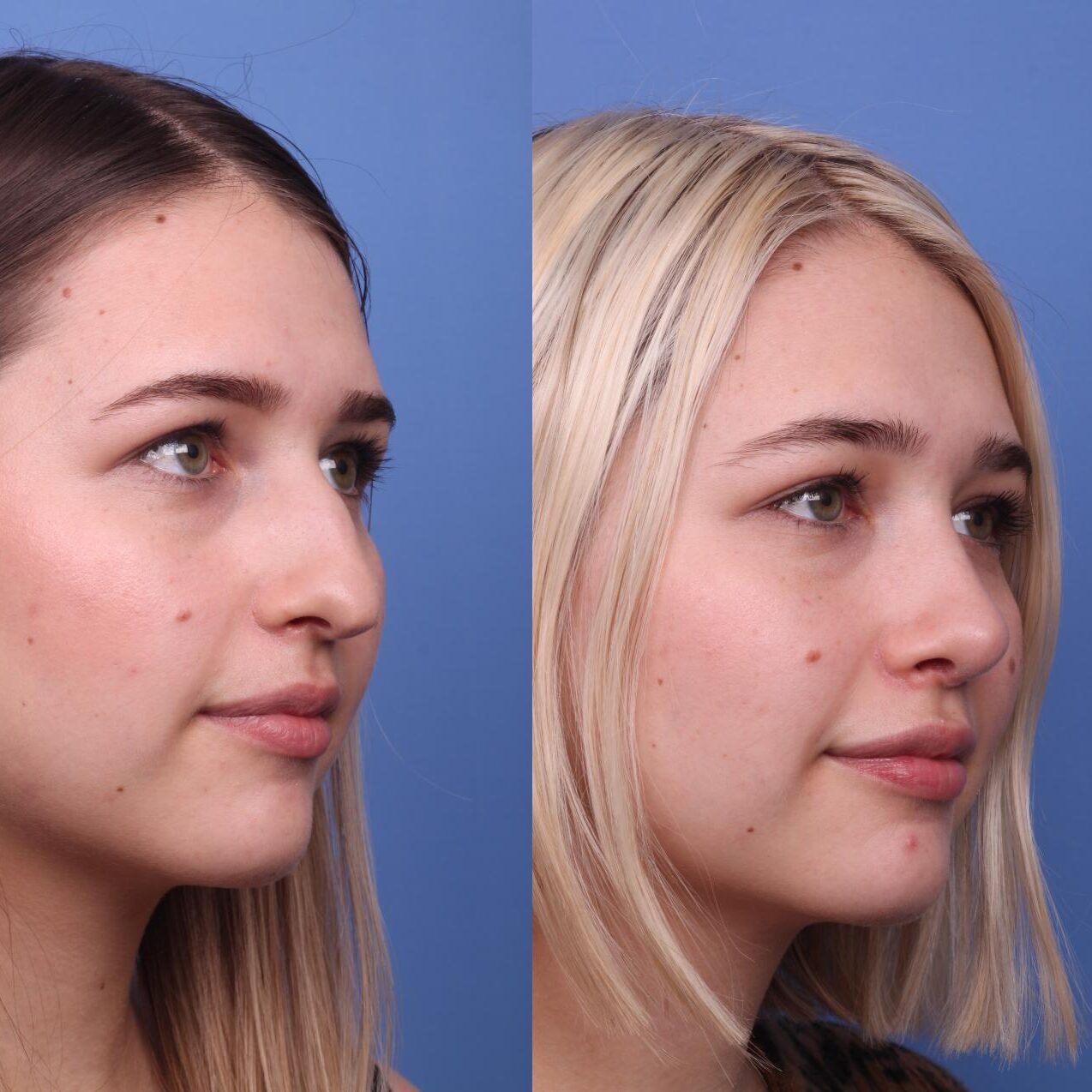 Insivo - Rhinoplasty