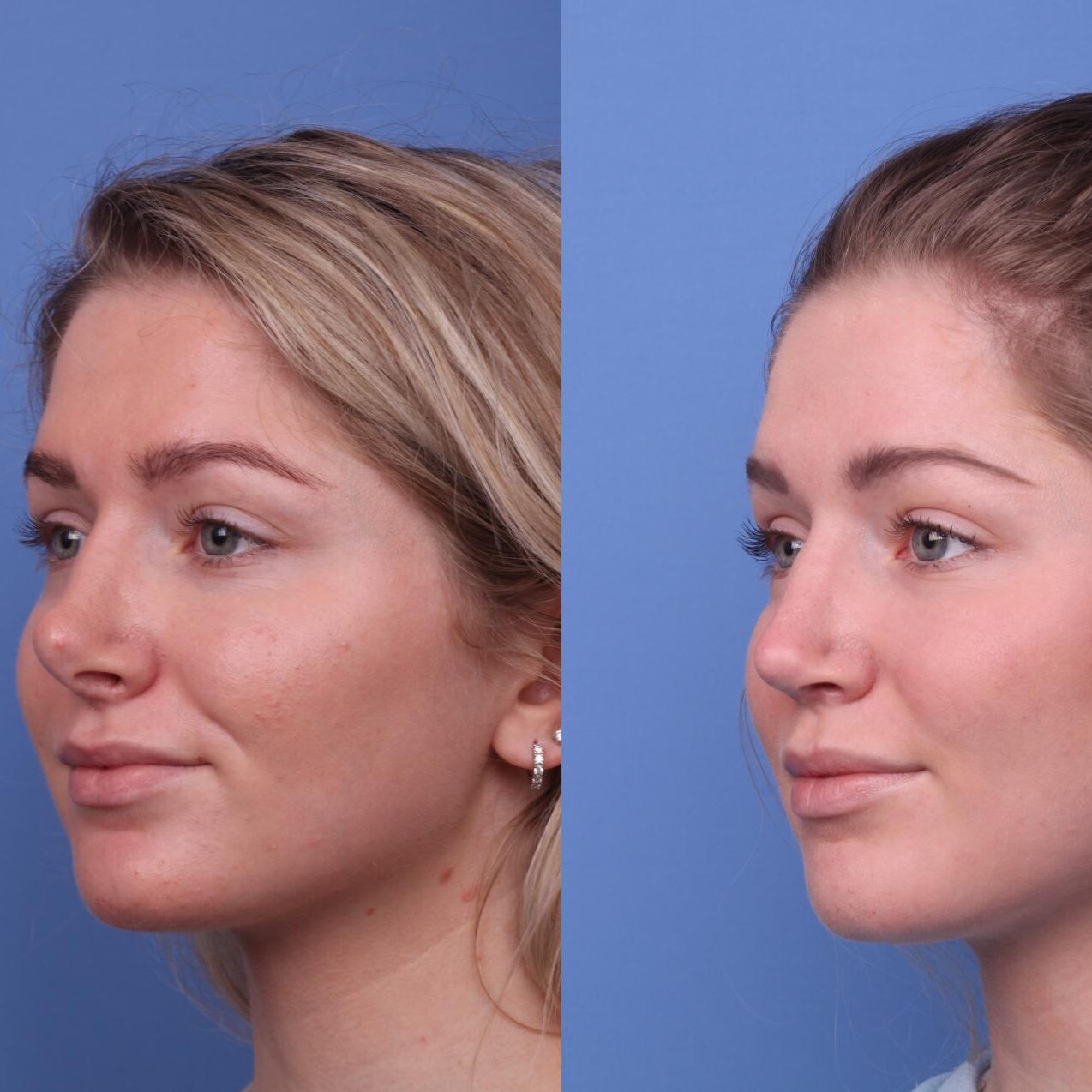 Insivo - Rhinoplasty